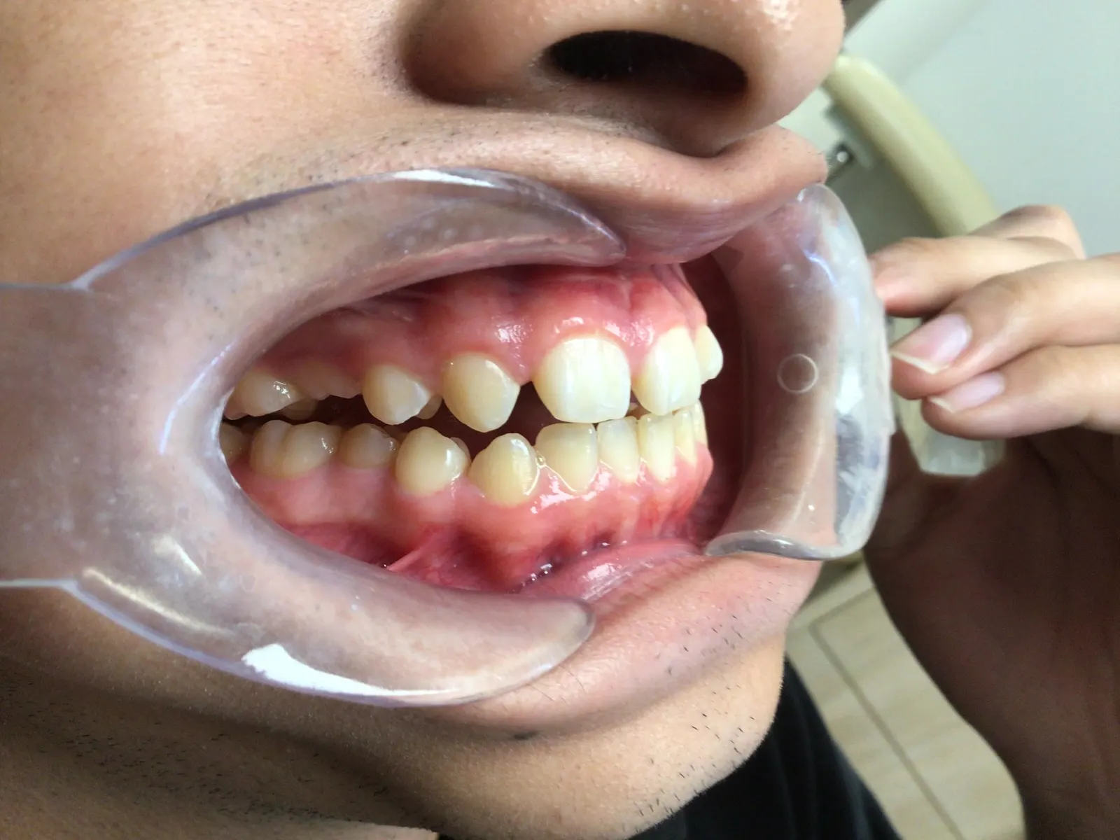 Before Invisalign Treatment